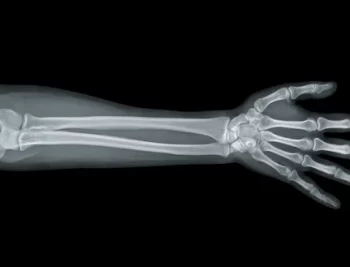 hand-xray-view-on-black-600nw-170958860